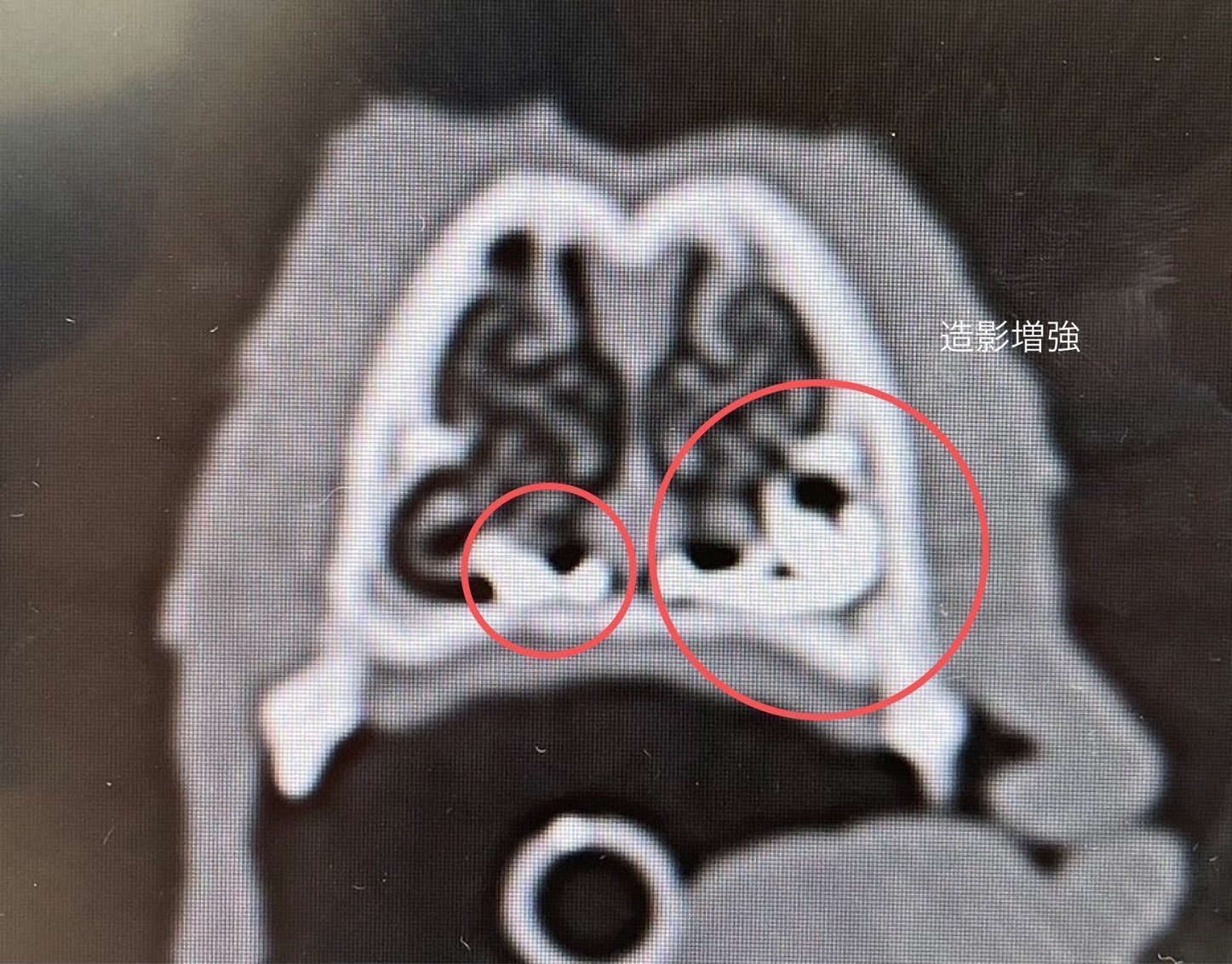 鼻涙管造影検査